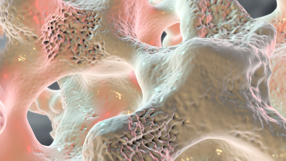 Osteoporosis: A look at alternative therapy options